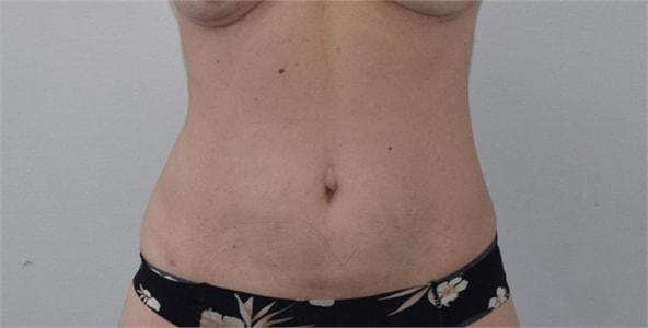 Elliot M. Hirsch, MD liposuction after — Los Angeles, CA
