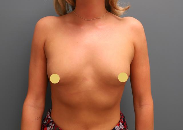 Breast Augmentation before at The Lucas Center Cosmetic & Plastic Surgery in Knoxville, TN