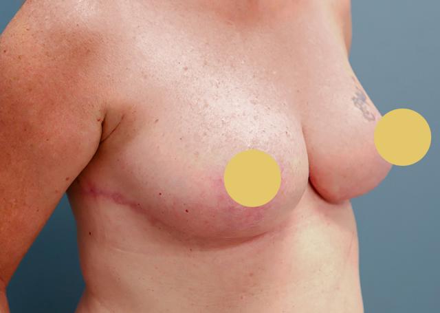 Breast Reduction after at The Lucas Center Cosmetic & Plastic Surgery in Knoxville, TN