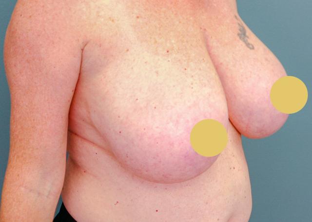 Breast Reduction before at The Lucas Center Cosmetic & Plastic Surgery in Knoxville, TN