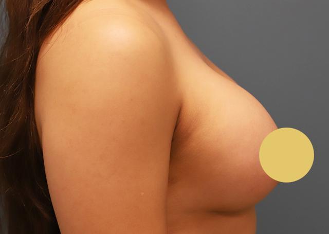 Breast Augmentation after at The Lucas Center Cosmetic & Plastic Surgery in Knoxville, TN