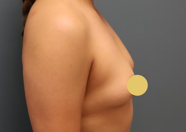 Breast Augmentation before at The Lucas Center Cosmetic & Plastic Surgery in Knoxville, TN