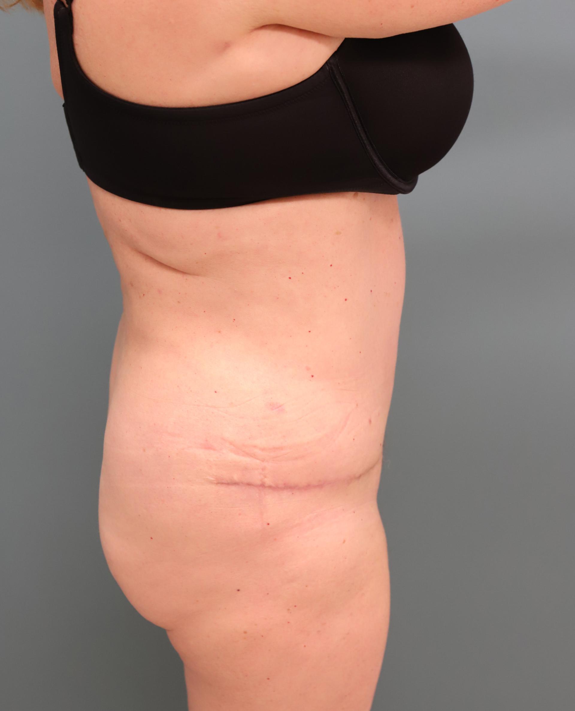 The Lucas Center Cosmetic & Plastic Surgery tummy tuck after — Knoxville, TN