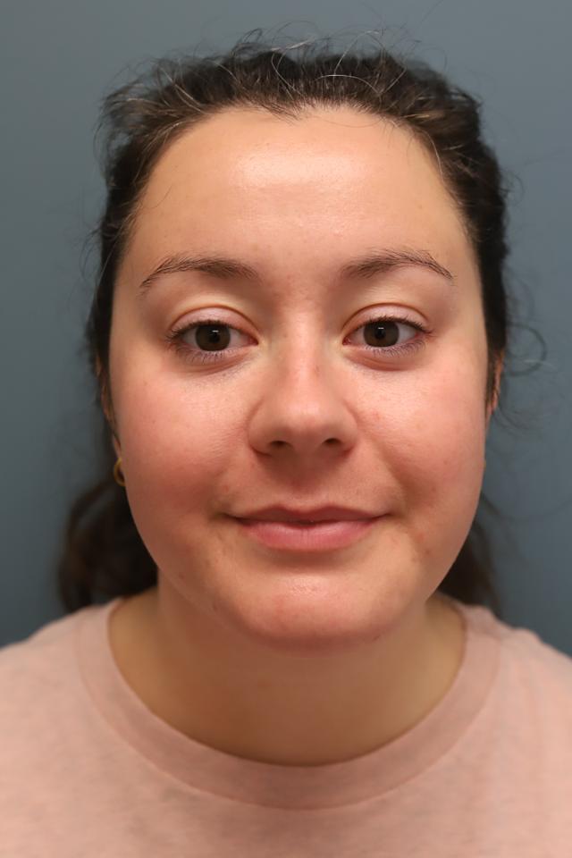 Liposuction after at The Lucas Center Cosmetic & Plastic Surgery in Knoxville, TN
