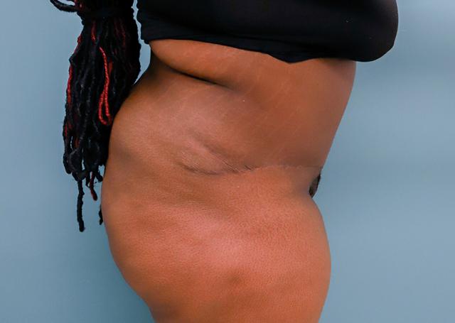 Tummy Tuck after at The Lucas Center Cosmetic & Plastic Surgery in Knoxville, TN