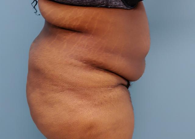 Tummy Tuck before at The Lucas Center Cosmetic & Plastic Surgery in Knoxville, TN