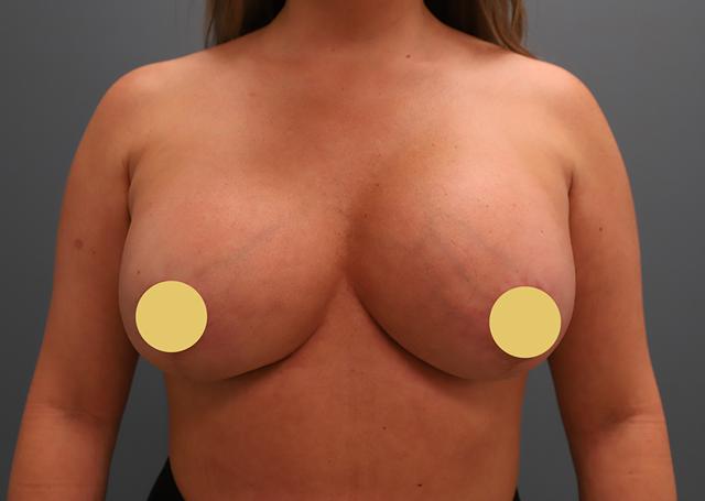 Breast Augmentation after at The Lucas Center Cosmetic & Plastic Surgery in Knoxville, TN