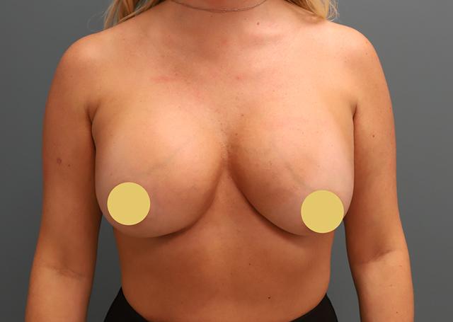 Breast Augmentation before at The Lucas Center Cosmetic & Plastic Surgery in Knoxville, TN