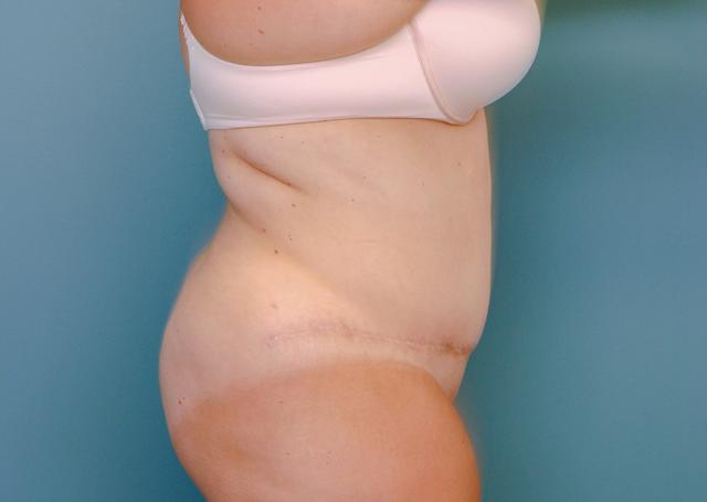 Tummy Tuck after at The Lucas Center Cosmetic & Plastic Surgery in Knoxville, TN
