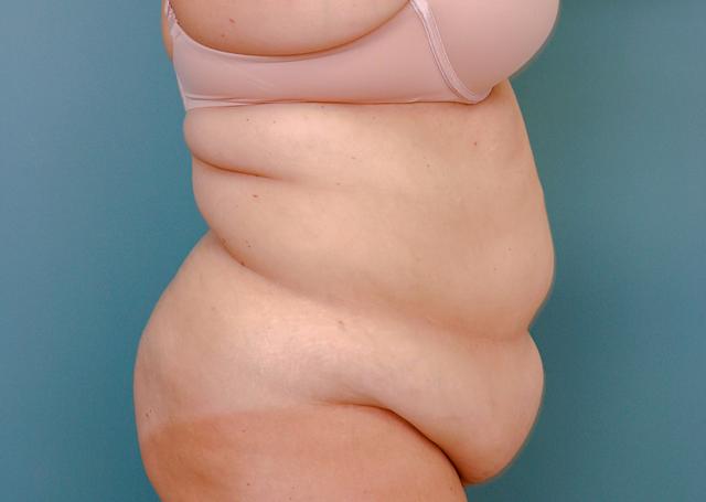 Tummy Tuck before at The Lucas Center Cosmetic & Plastic Surgery in Knoxville, TN