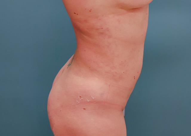 Liposuction after at The Lucas Center Cosmetic & Plastic Surgery in Knoxville, TN