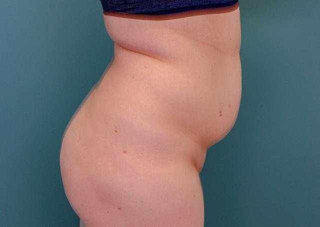 Liposuction before at The Lucas Center Cosmetic & Plastic Surgery in Knoxville, TN