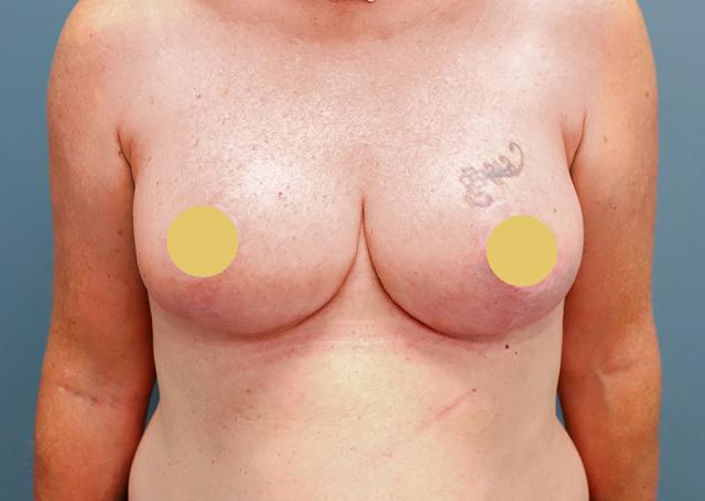Breast Reduction after at The Lucas Center Cosmetic & Plastic Surgery in Knoxville, TN