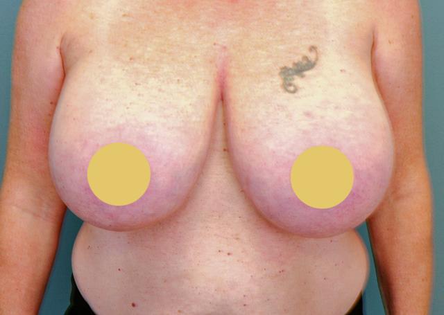 Breast Reduction before at The Lucas Center Cosmetic & Plastic Surgery in Knoxville, TN