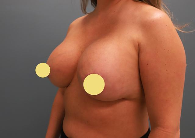 Breast Augmentation after at The Lucas Center Cosmetic & Plastic Surgery in Knoxville, TN