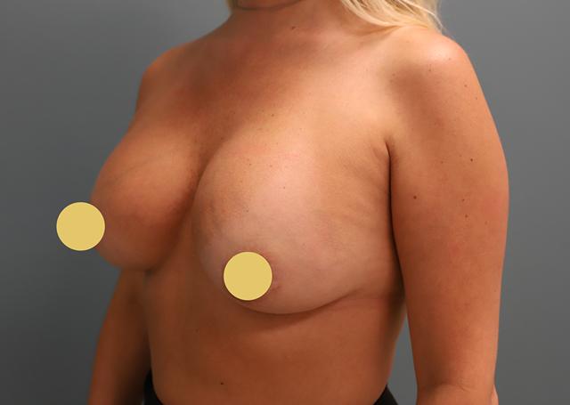 Breast Augmentation before at The Lucas Center Cosmetic & Plastic Surgery in Knoxville, TN