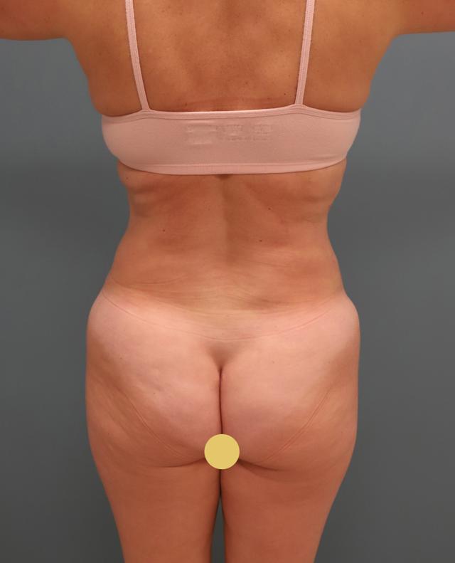 Liposuction after at The Lucas Center Cosmetic & Plastic Surgery in Knoxville, TN
