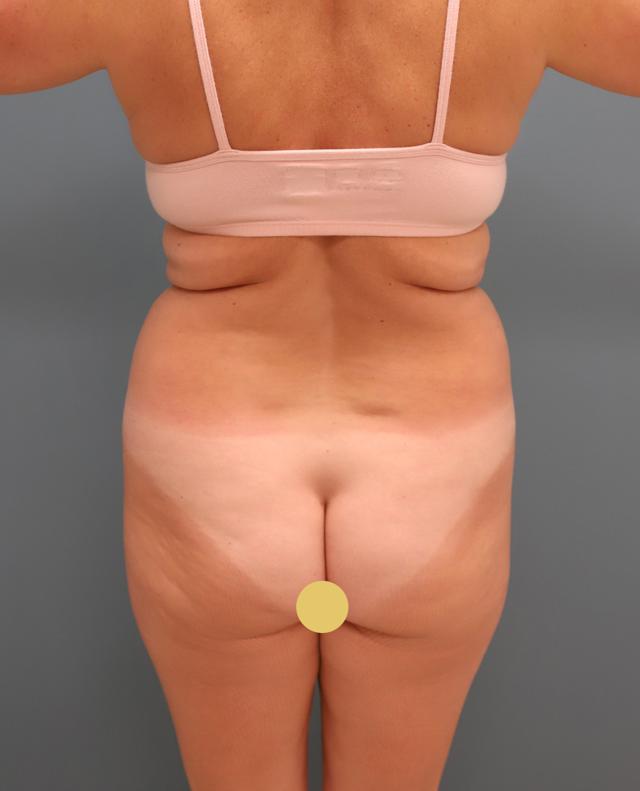 Liposuction before at The Lucas Center Cosmetic & Plastic Surgery in Knoxville, TN