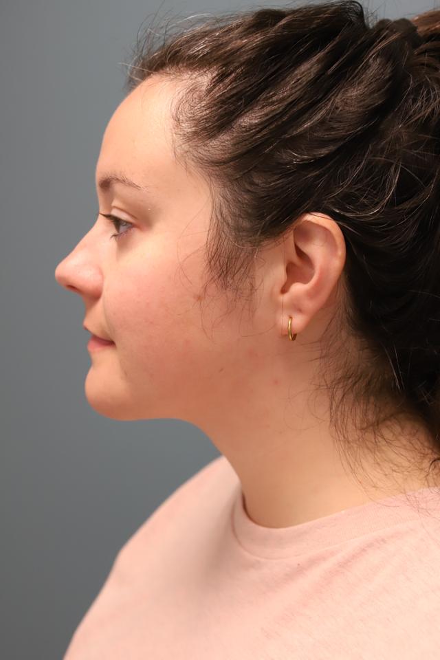 Liposuction after at The Lucas Center Cosmetic & Plastic Surgery in Knoxville, TN
