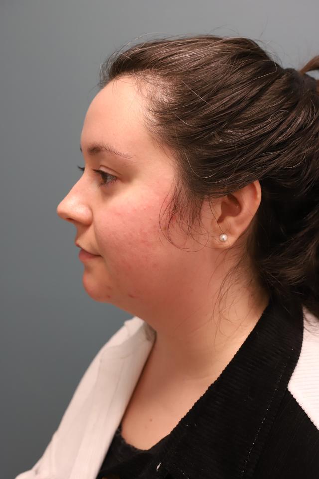 Liposuction before at The Lucas Center Cosmetic & Plastic Surgery in Knoxville, TN