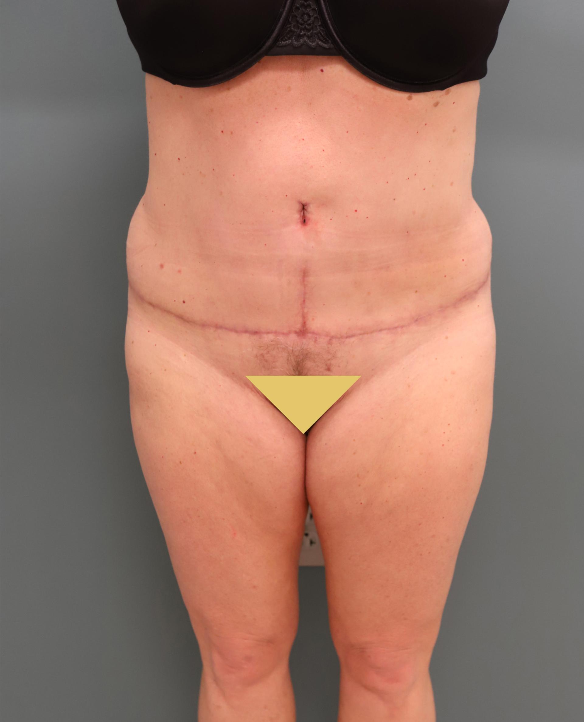 The Lucas Center Cosmetic & Plastic Surgery tummy tuck after — Knoxville, TN