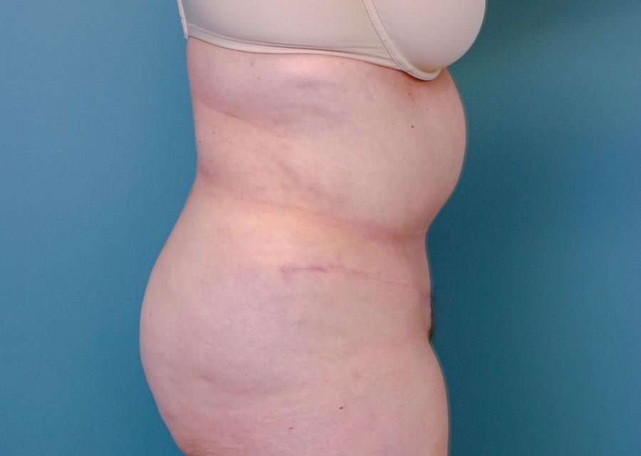 The Lucas Center Cosmetic & Plastic Surgery tummy tuck after — Knoxville, TN