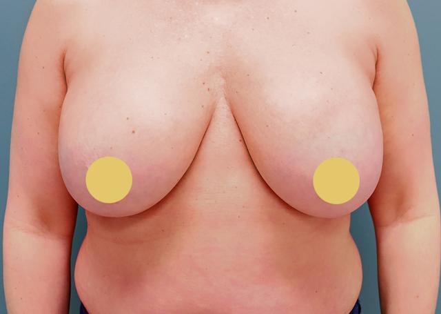 Breast Lift before at The Lucas Center Cosmetic & Plastic Surgery in Knoxville, TN