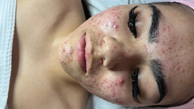 Laser Skin Resurfacing result at Forever Young Aesthetics in Seattle, WA
