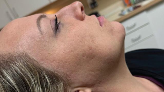 Laser Skin Resurfacing result at Forever Young Aesthetics in Seattle, WA