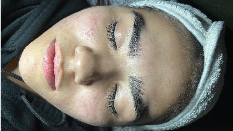 Forever Young Aesthetics microneedling result — Seattle, WA