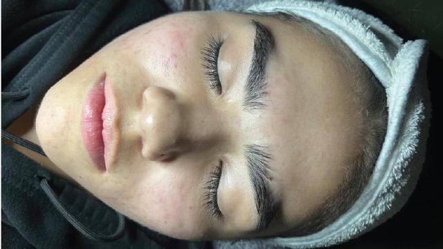 Laser Skin Resurfacing result at Forever Young Aesthetics in Seattle, WA