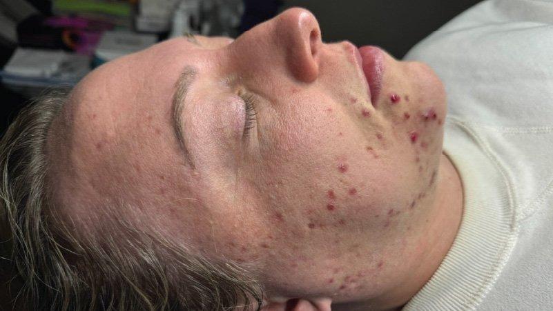 Forever Young Aesthetics microneedling result — Seattle, WA