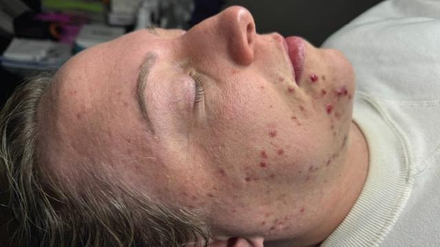Laser Skin Resurfacing result at Forever Young Aesthetics in Seattle, WA