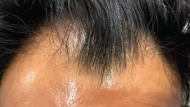 Microneedling result at Forever Young Aesthetics in Seattle, WA