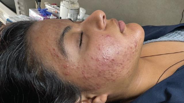 Laser Skin Resurfacing result at Forever Young Aesthetics in Seattle, WA
