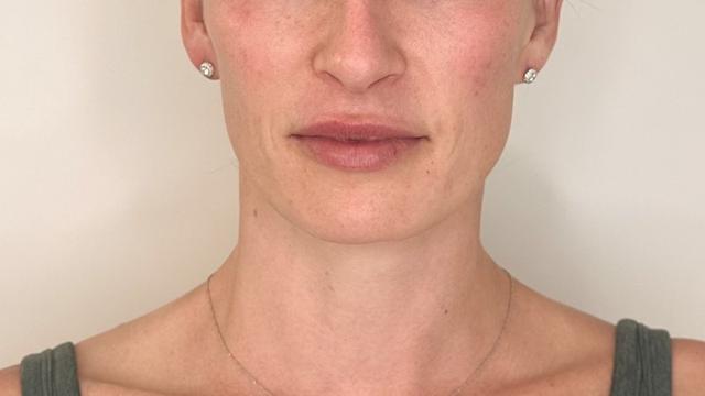 Botox result at Forever Young Aesthetics in Seattle, WA