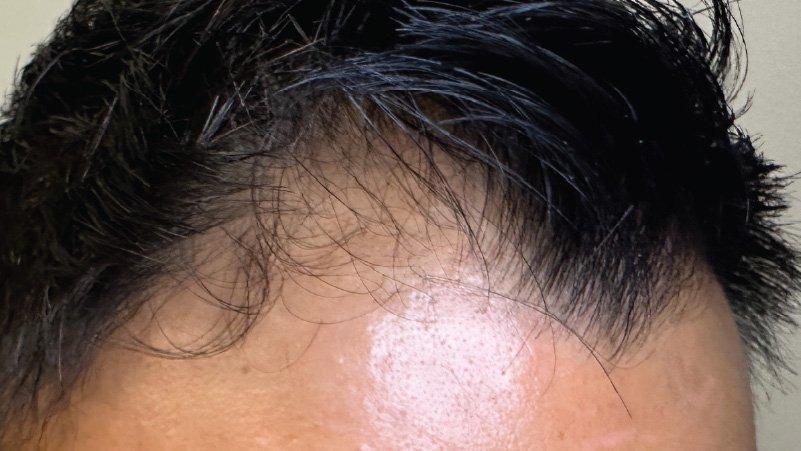 Forever Young Aesthetics microneedling result — Seattle, WA