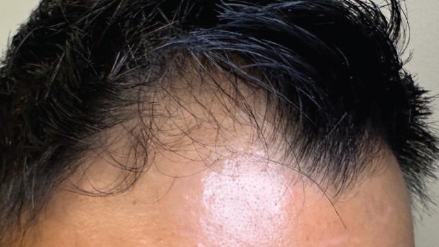 Laser Skin Resurfacing result at Forever Young Aesthetics in Seattle, WA