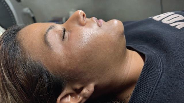 Laser Skin Resurfacing result at Forever Young Aesthetics in Seattle, WA