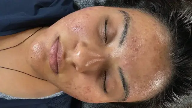 Laser Skin Resurfacing result at Forever Young Aesthetics in Seattle, WA
