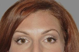 W. Matthew White, MD botox after — New York, NY