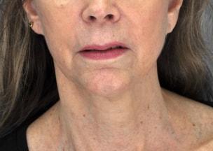 W. Matthew White, MD skin tightening after — New York, NY
