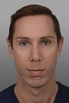 W. Matthew White, MD ear pinning after — New York, NY