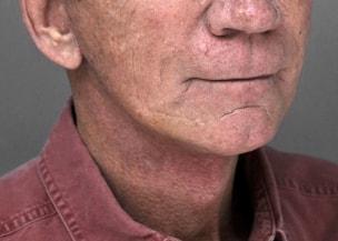 W. Matthew White, MD neck lift after — New York, NY
