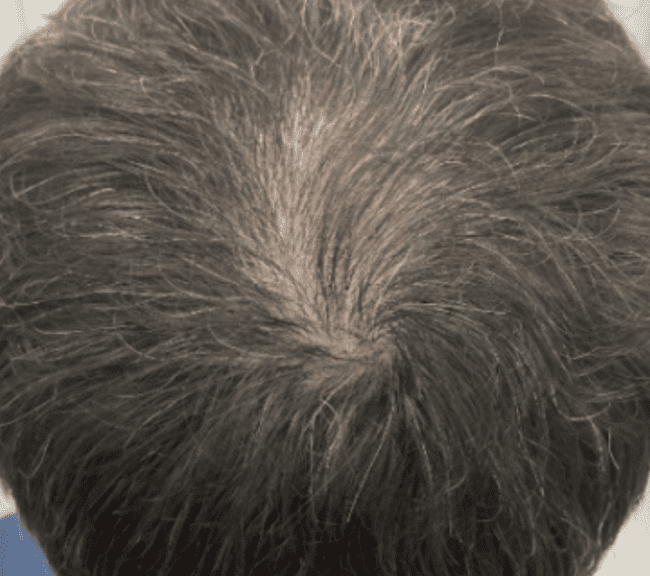 Applegate MedSpa hair restoration after — Covington, KY