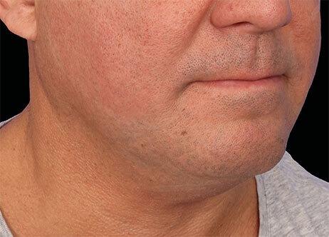 Applegate MedSpa after — Covington, KY