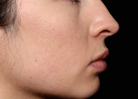 Applegate MedSpa microneedling after — Covington, KY