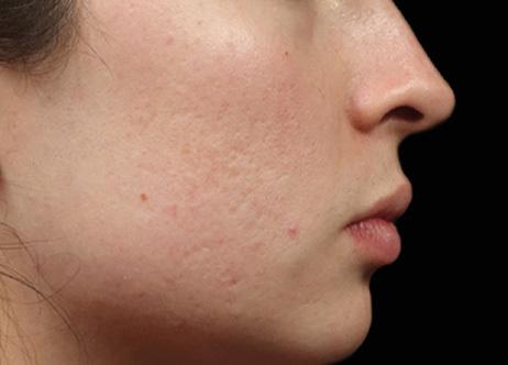 Laser Skin Resurfacing before at Applegate MedSpa in Covington, KY