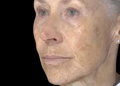 Laser Skin Resurfacing before at Applegate MedSpa in Covington, KY