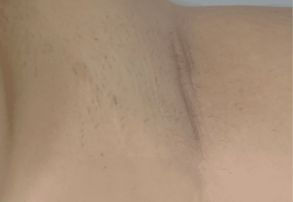 Applegate MedSpa after — Covington, KY